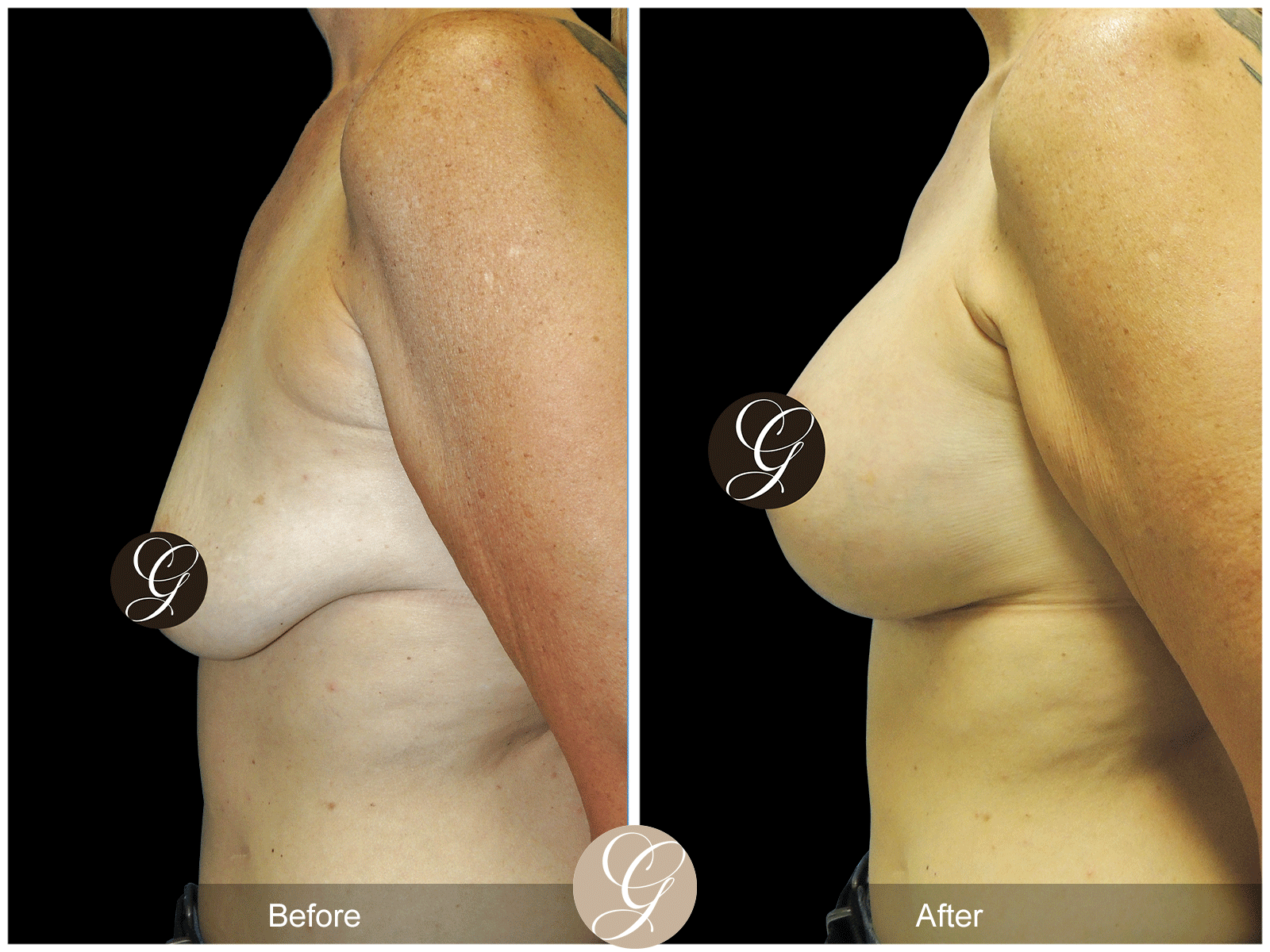 Breast Augmentation Pt 29 Image