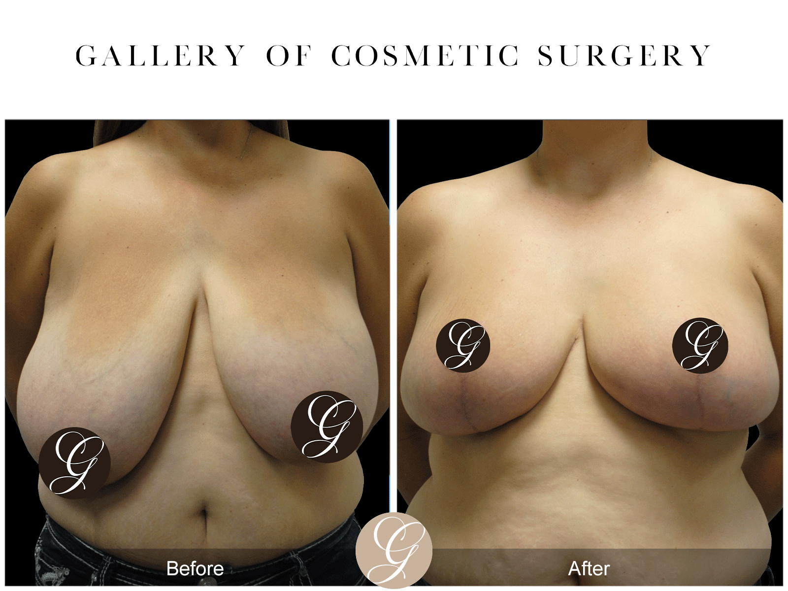 8 Medical Benefits of Undergoing a Breast Reduction | Reduction Mammaplasty Image