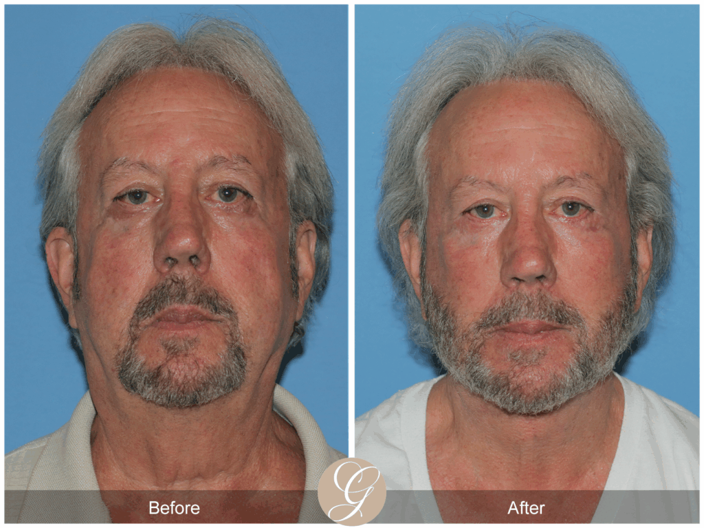 Deep Plane Neck Lift for Men: Achieve a Redefined Jawline Contouring in Newport Beach, CA