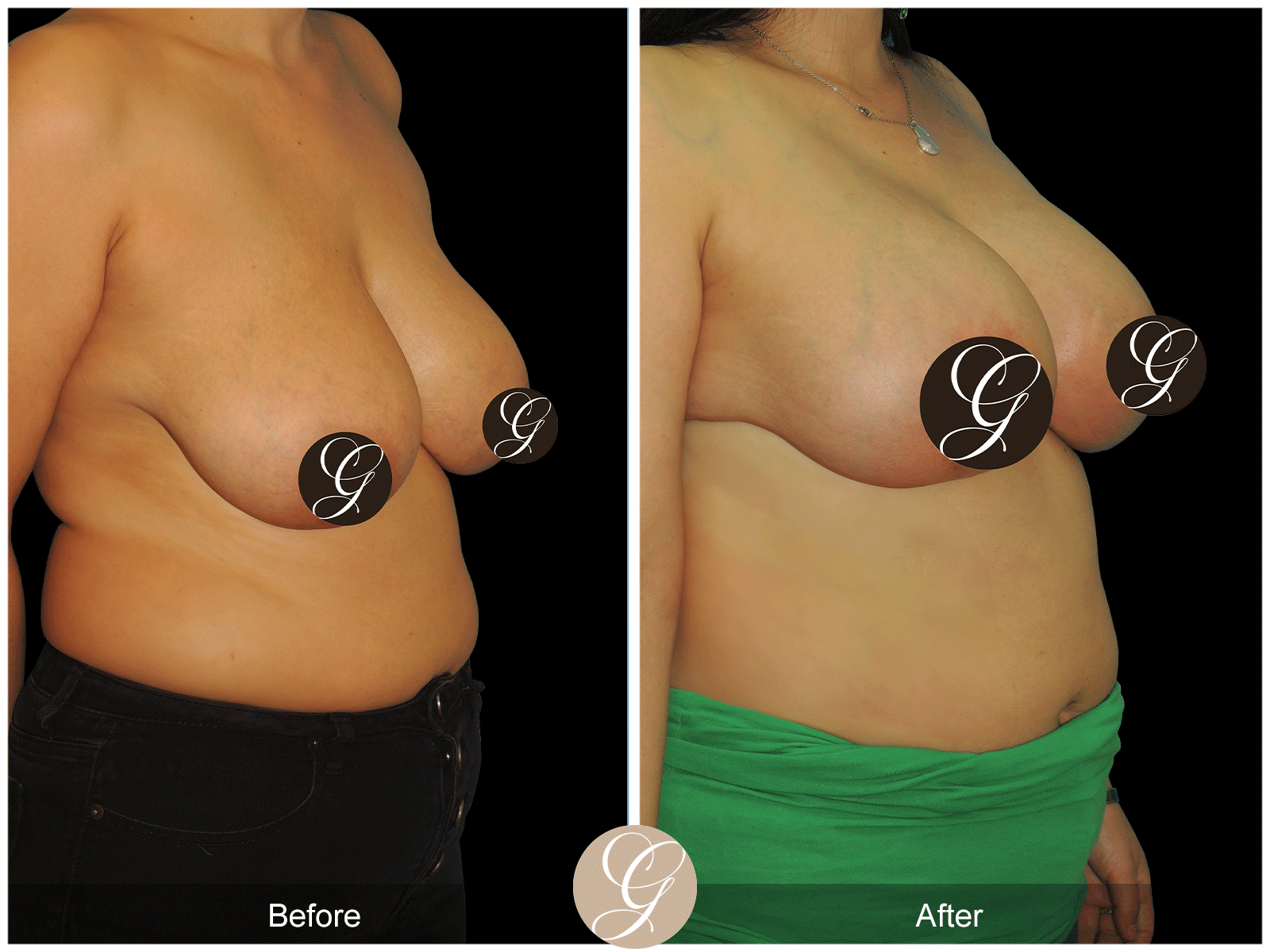 Breast Auto Augmentation Image