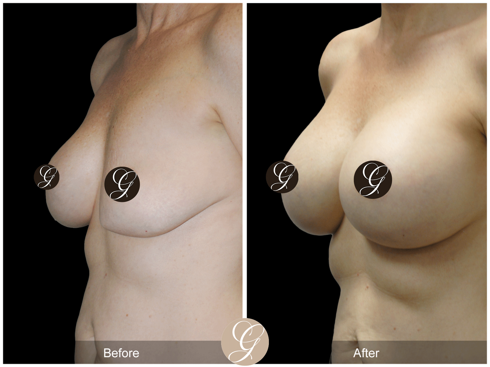 Breast Explant & Augmentation Image