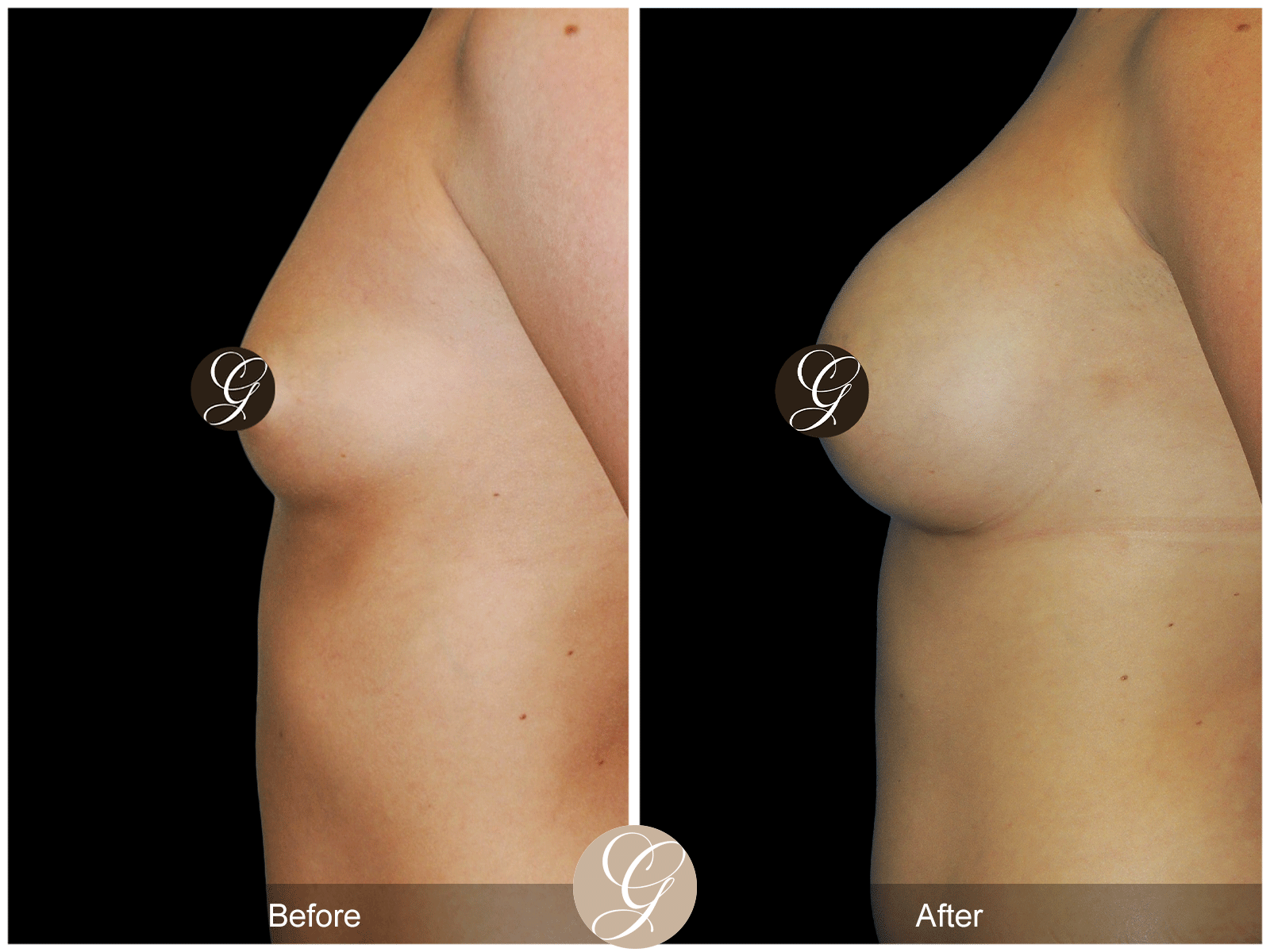 Breast Augmentation Pt 24 Image