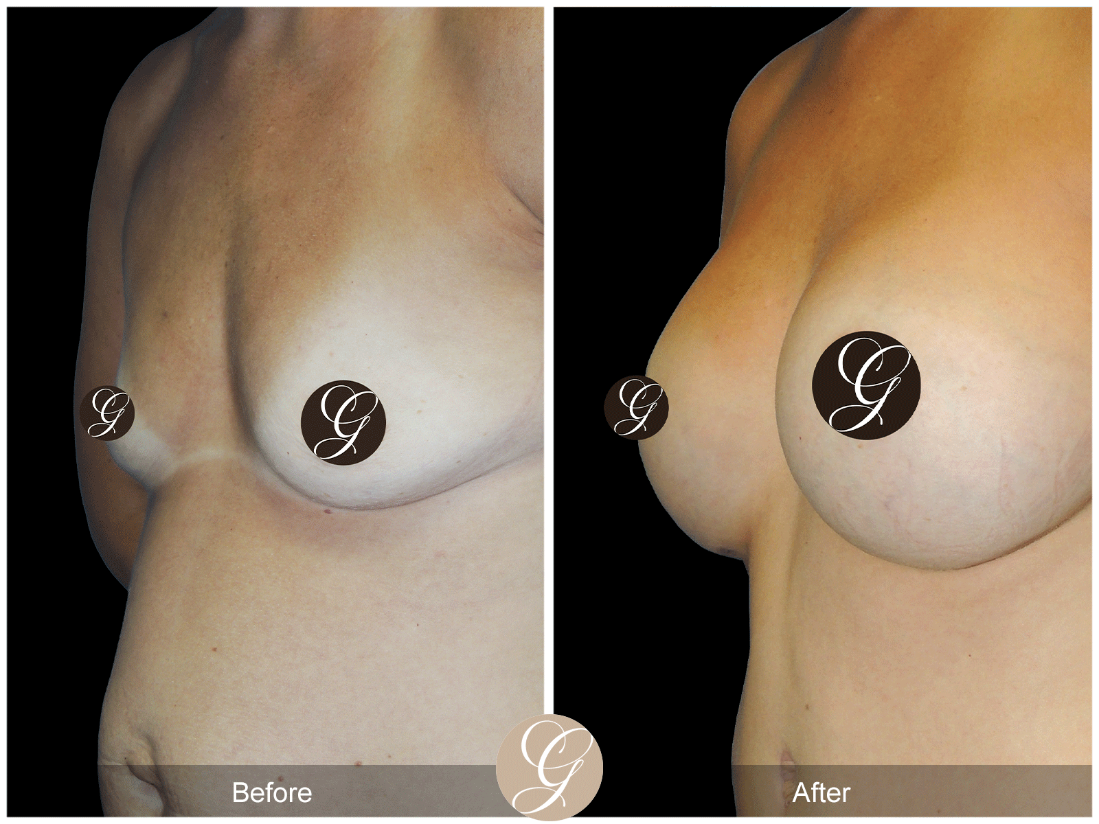 Breast Augmentation Pt 25 Image