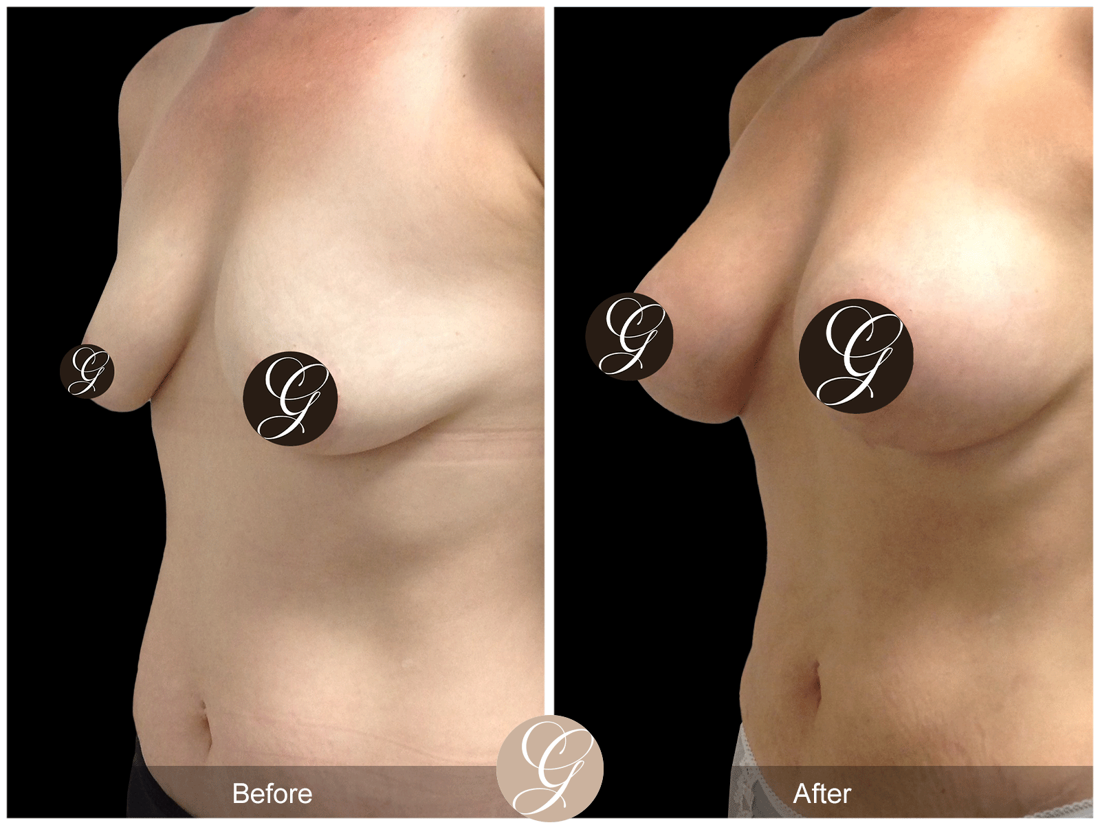 Breast Augmentation Pt 26 Image