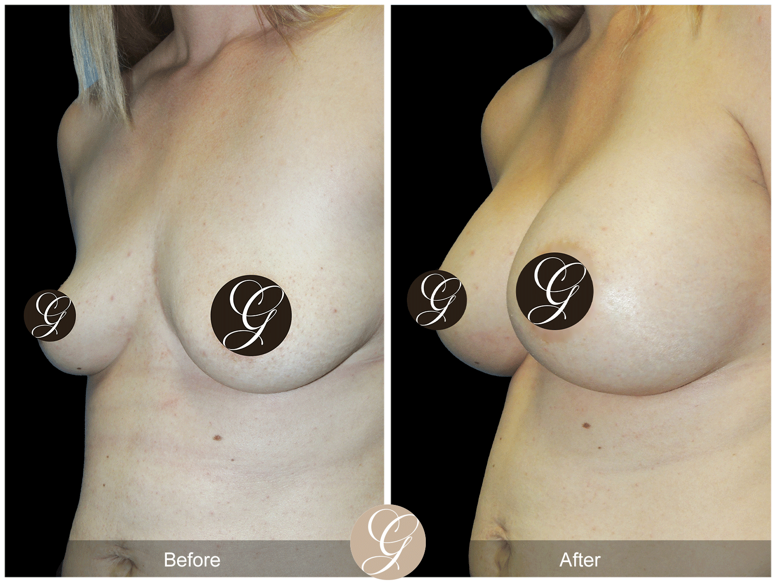 Breast Augmentation Pt 27 Image