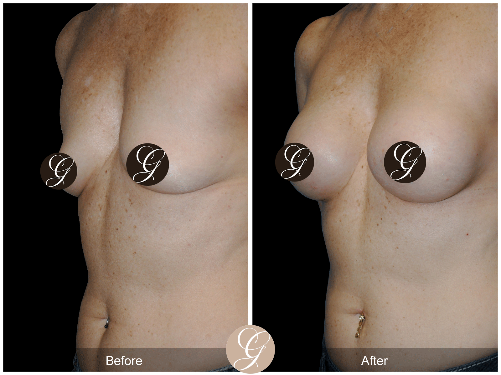 Breast Augmentation Pt 28 Image