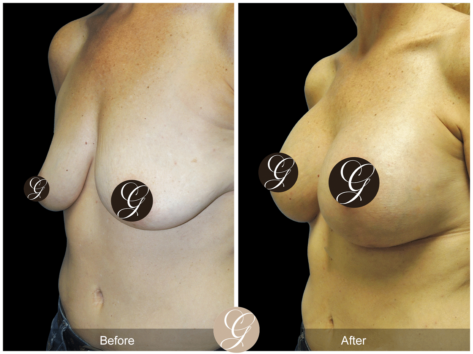 Breast Augmentation Pt 29 Image