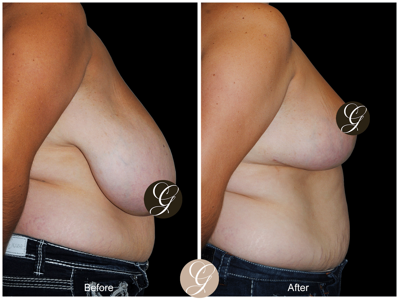 Breast Reduction Image