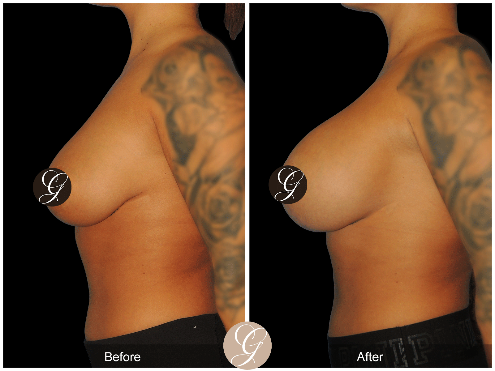 Breast Augmentation with Lift & Mesh Image