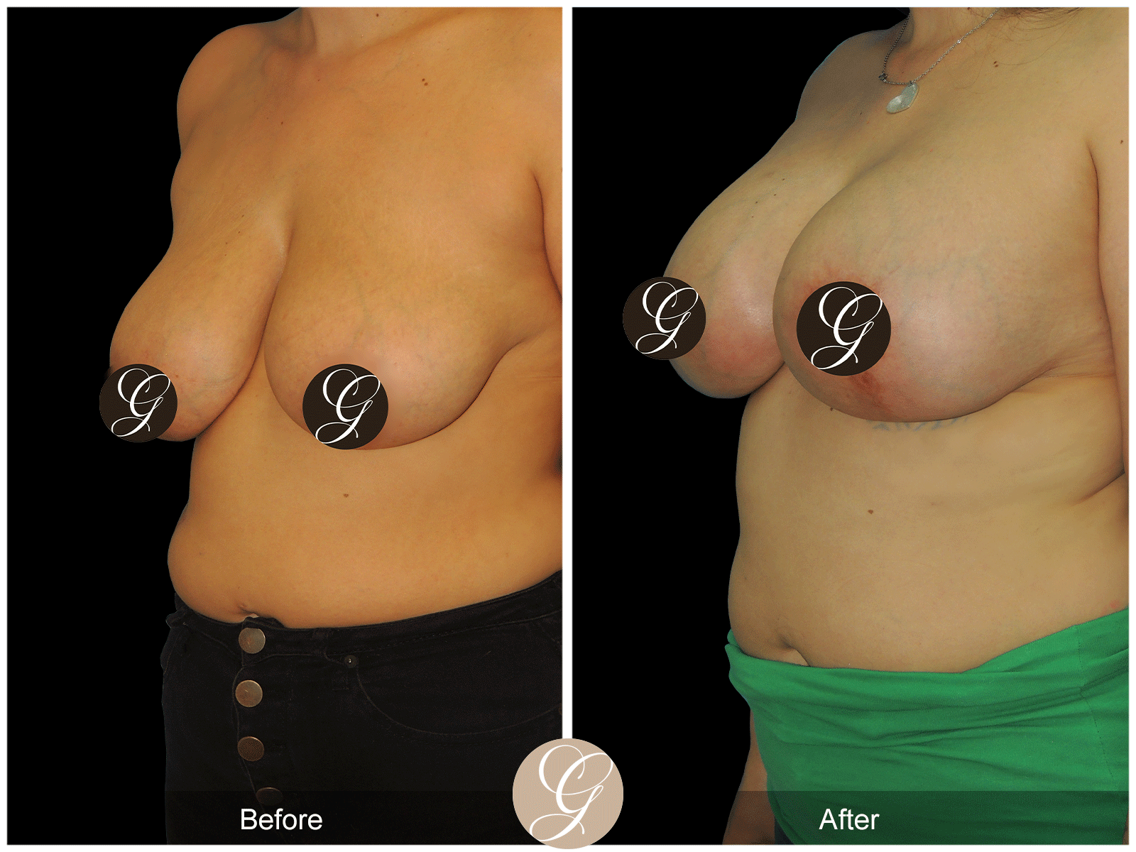 Breast Auto Augmentation Image