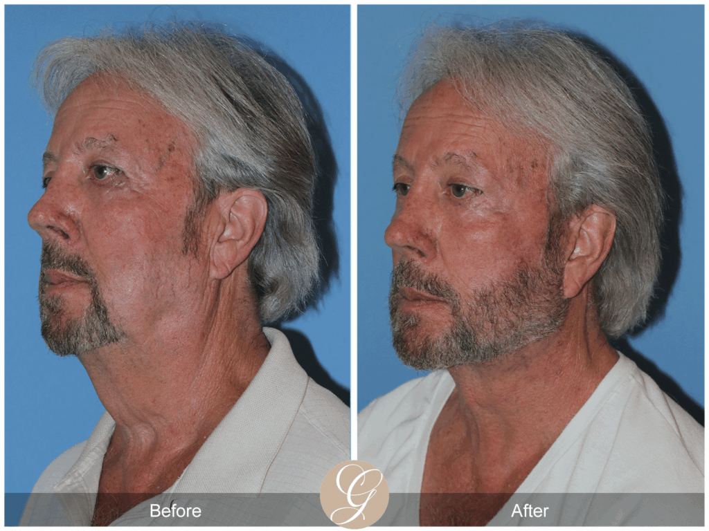 Deep Plane Neck Lift for Men: Achieve a Redefined Jawline Contouring in Newport Beach, CA