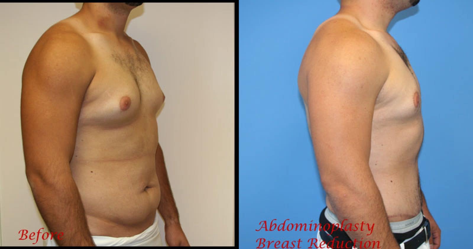 Breast Reduction For Men Image