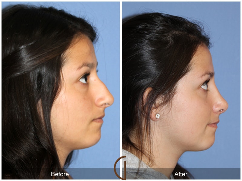 Considering a Rhinoplasty? What You Need to Know Before You Schedule Your Consultation Image
