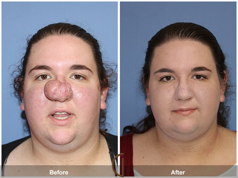 This Thanksgiving a Newport Beach Facial Plastic Surgeon has given a young Girl’s Life Back Image