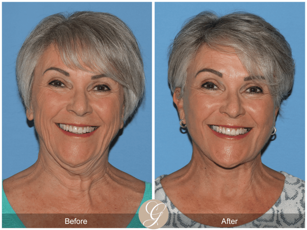 Deep Plane Facelift and Deep Plane NeckLift Case 1