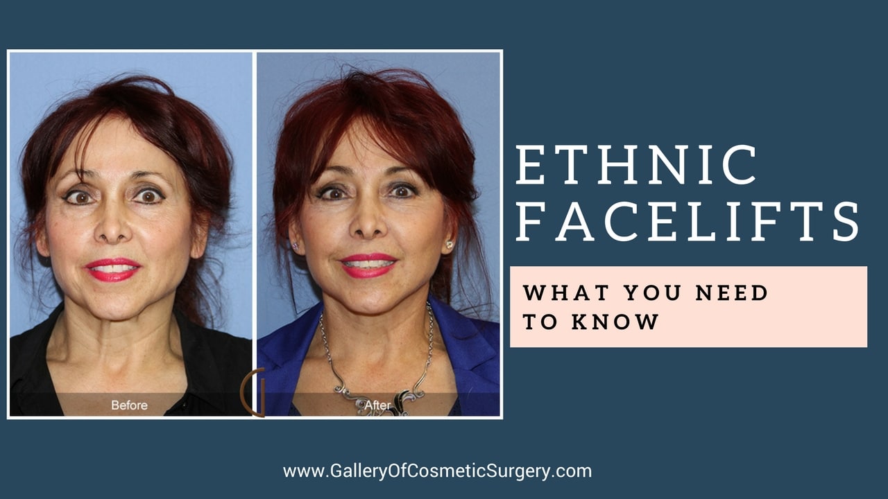 Ethnic Facelift – What You Need To Know Image