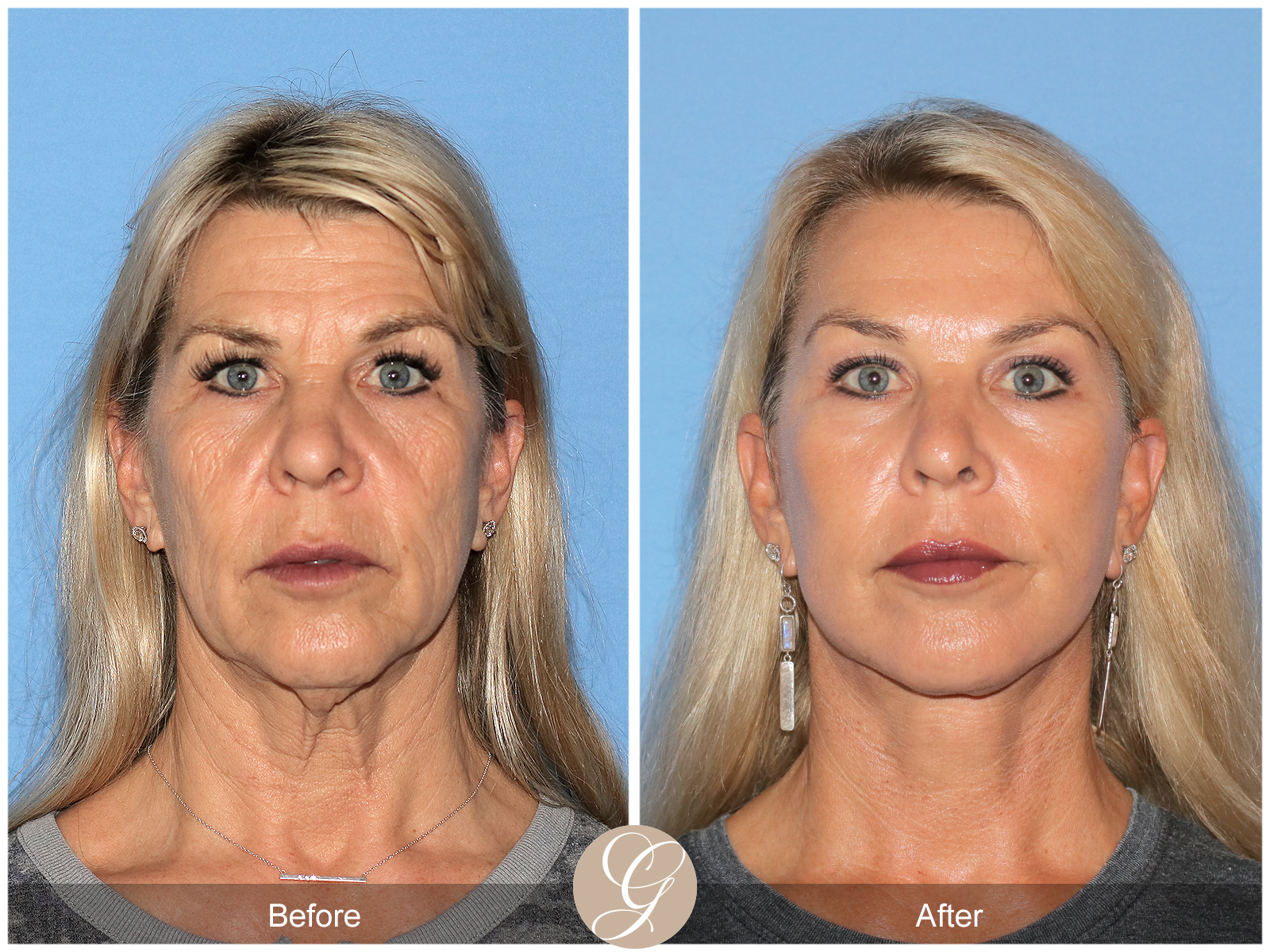 The Future of Facial Rejuvenation: The Preservation Deep Plane Facelift by Dr. Kevin Sadati Image