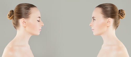 Understanding Revision Rhinoplasty & Why Patient’s Want This Procedure Image