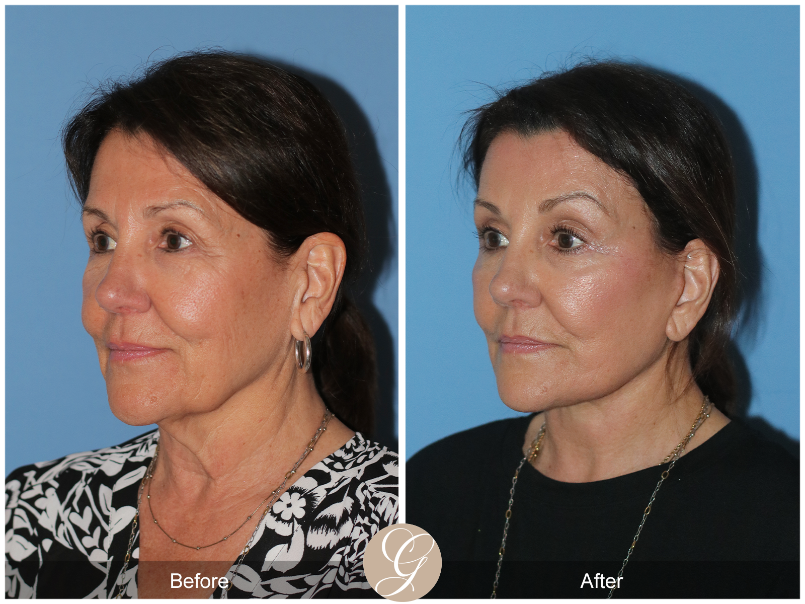 Preservation Deep Plane Facelift Case 25 Image