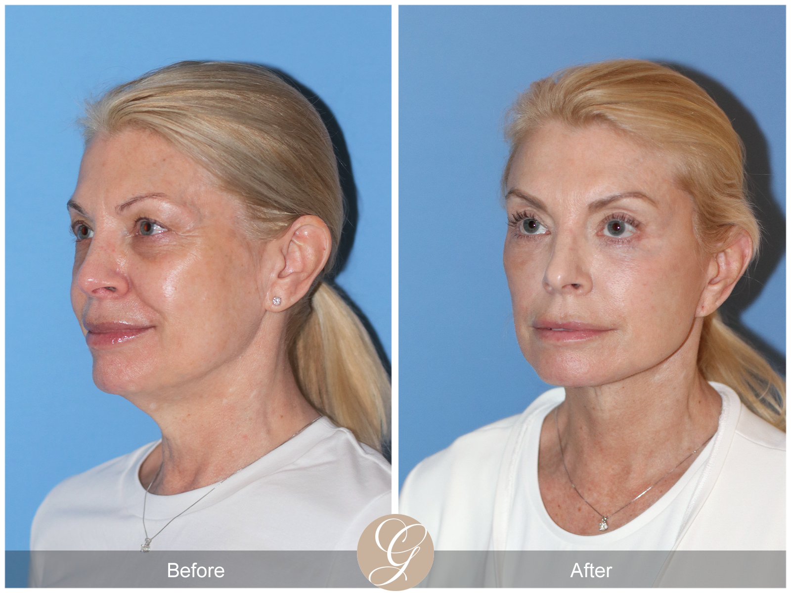 Preservation Deep Plane Facelift Case 26 Image