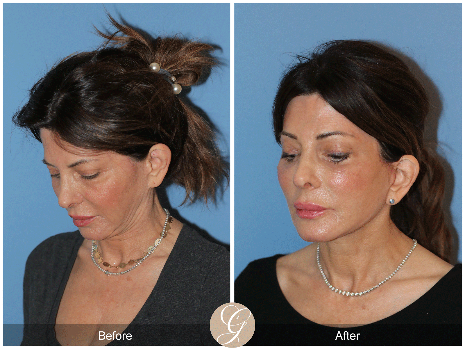 Preservation Deep Plane Facelift Case 27 Image