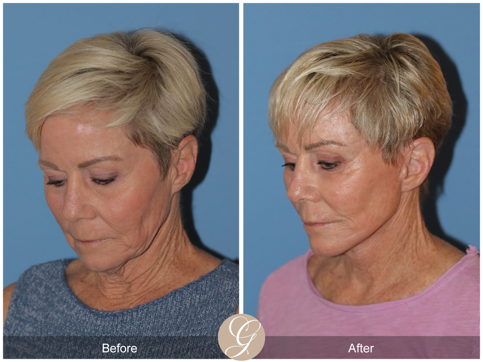 Preservation Deep Plane Facelift Case 28 Image