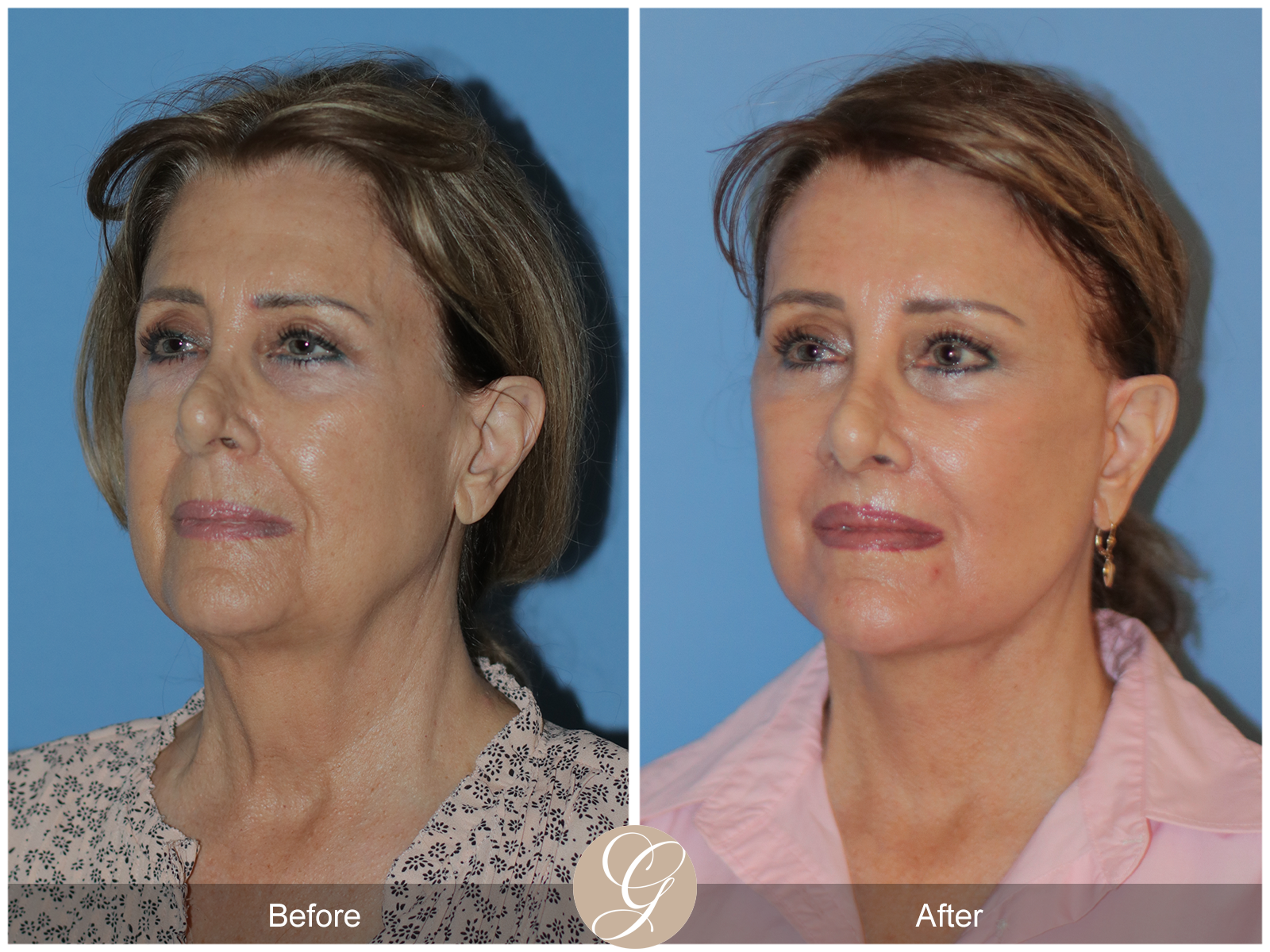 Preservation Deep Plane Facelift Case 30 Image