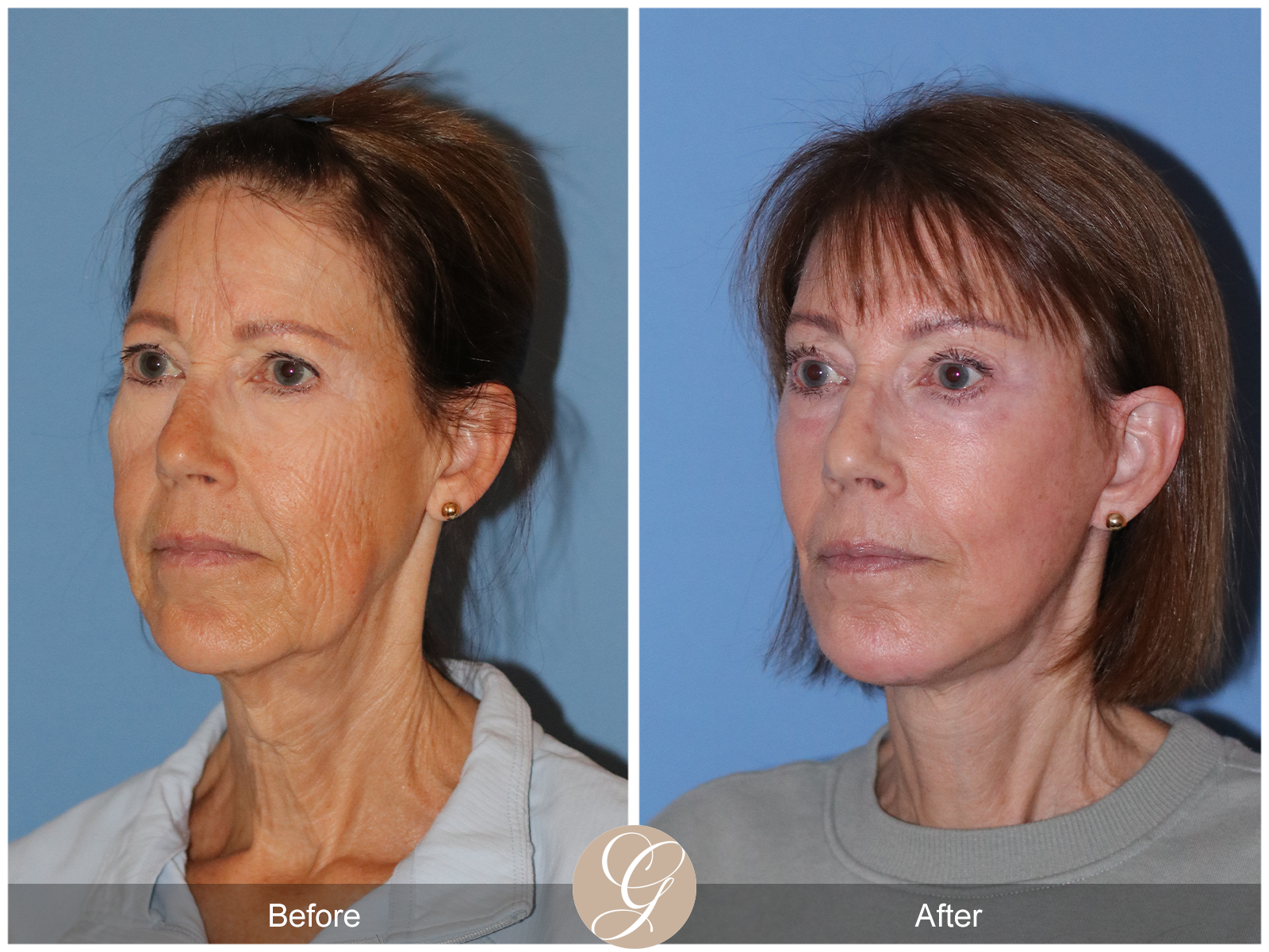 Preservation Deep Plane Facelift Case 32 Image