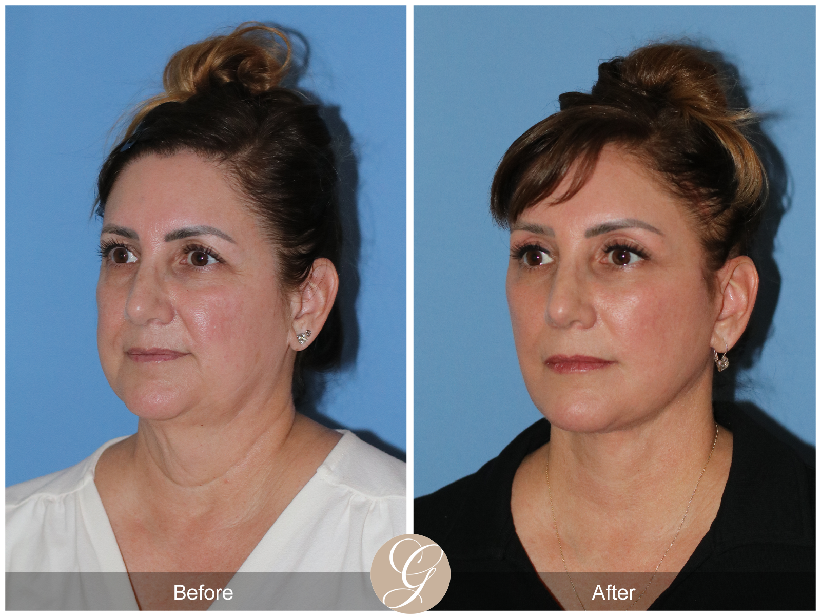 Preservation Deep Plane Facelift Case 33 Image