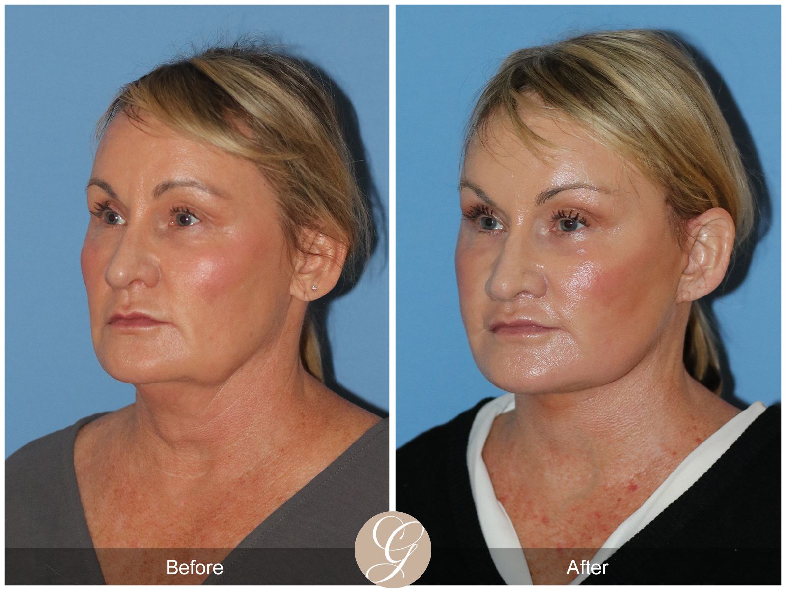 Preservation Deep Plane Facelift Case 34 Image