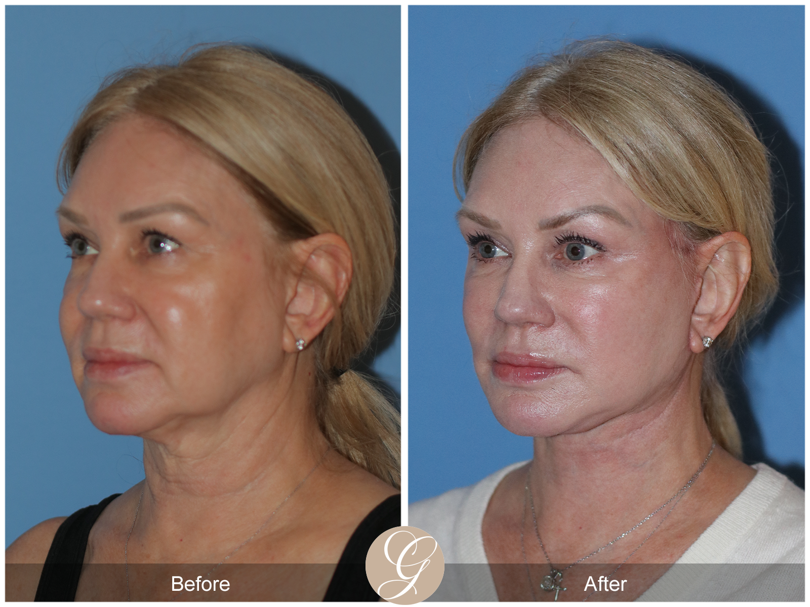 Deep Plane Facelift Case 26 Image