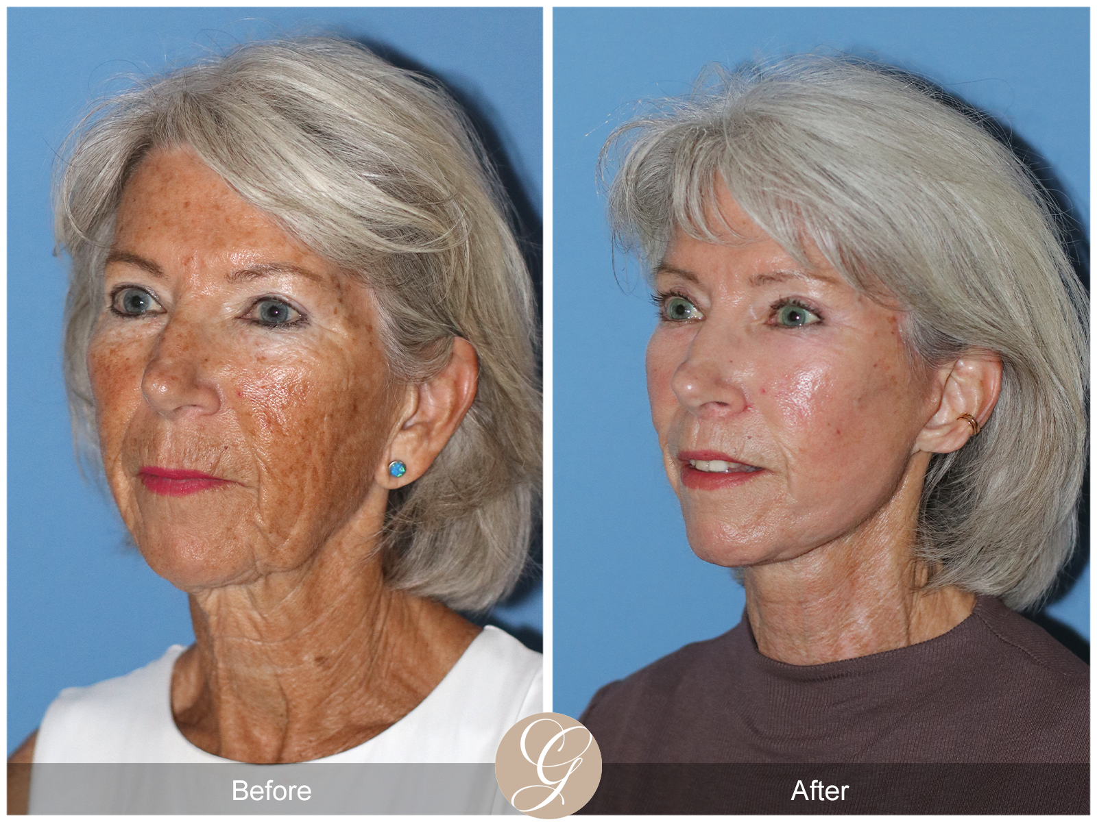 Preservation Deep Plane Facelift Case 24 Image