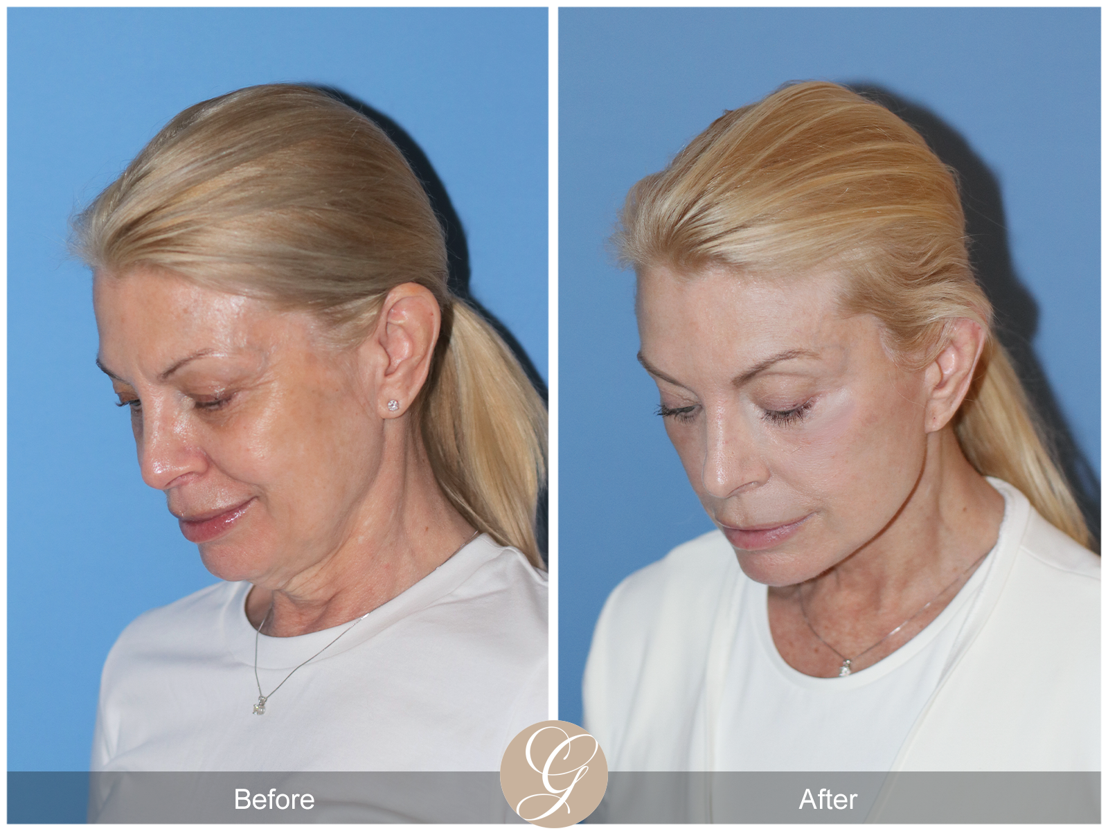 Preservation Deep Plane Facelift Case 26 Image