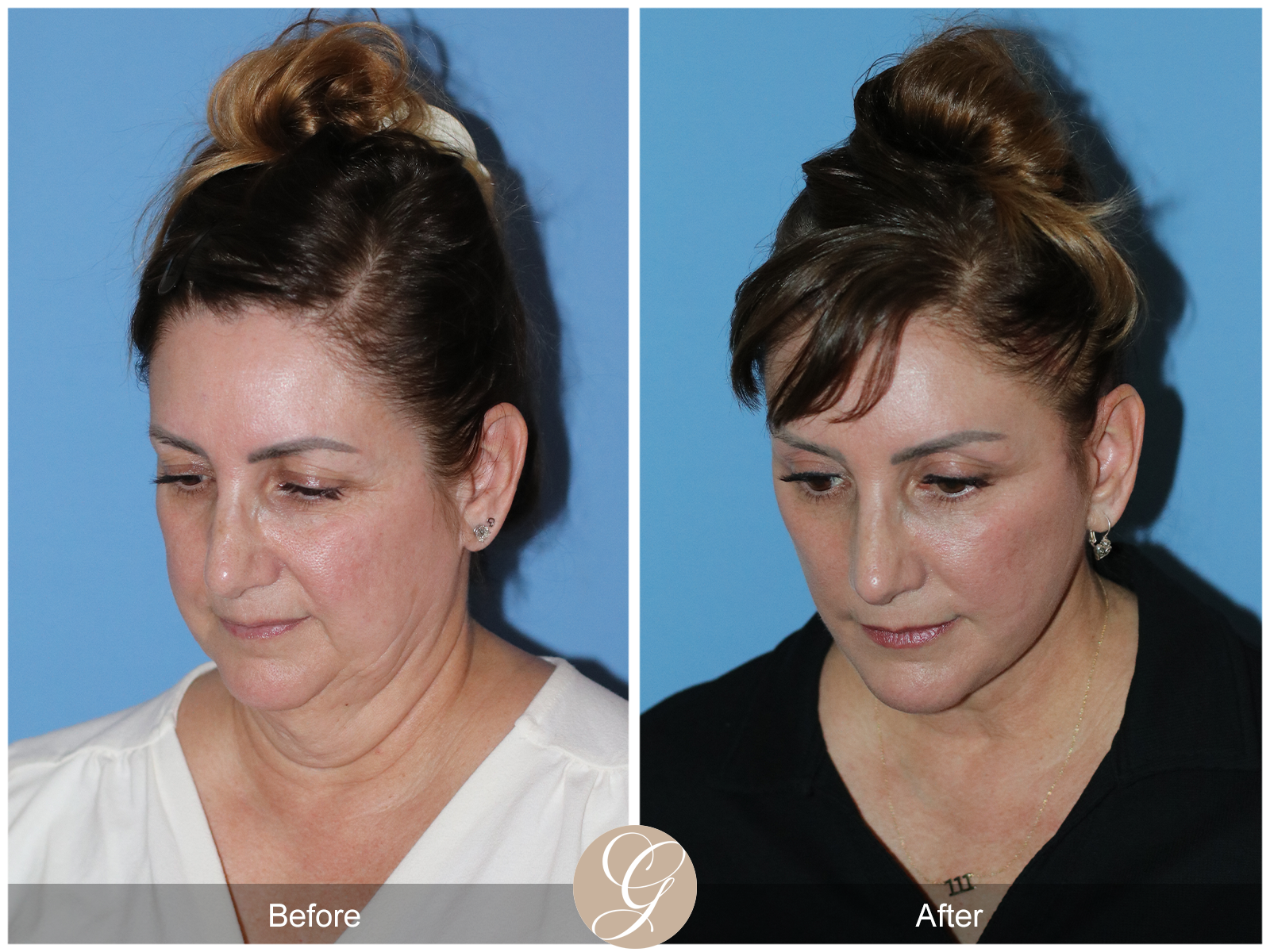 Preservation Deep Plane Facelift Case 33 Image