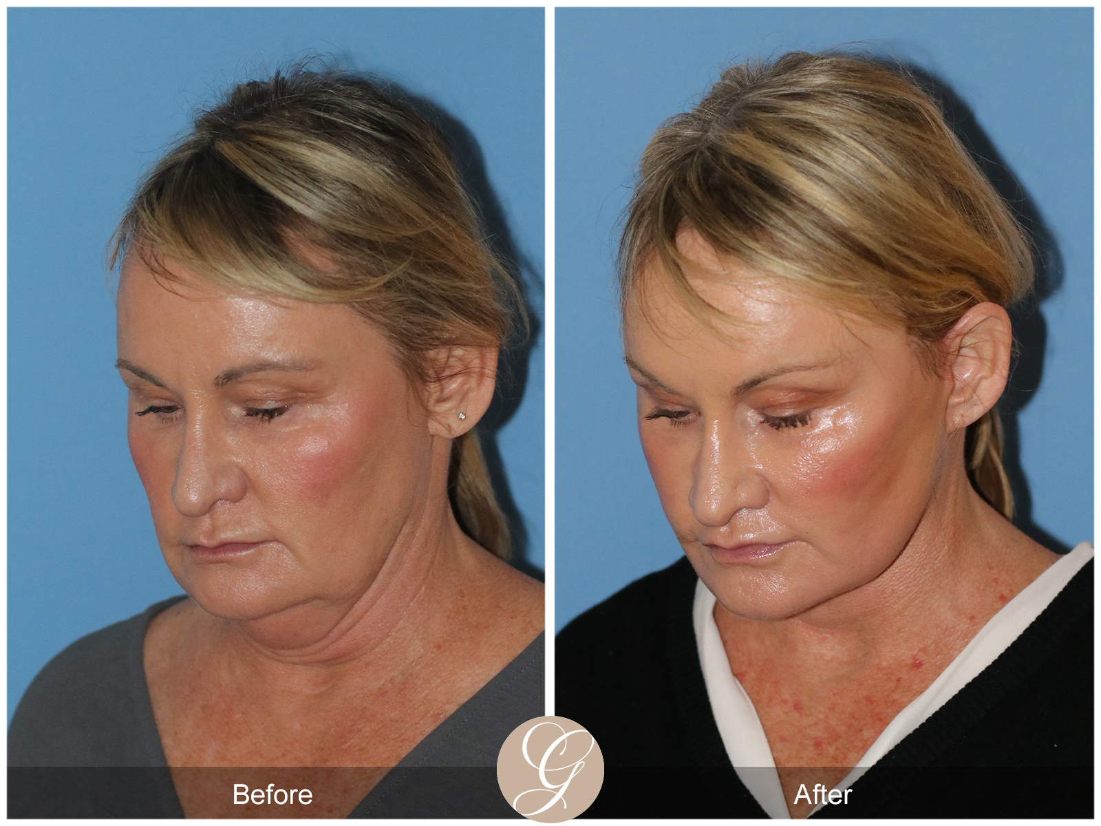 Preservation Deep Plane Facelift Case 34 Image