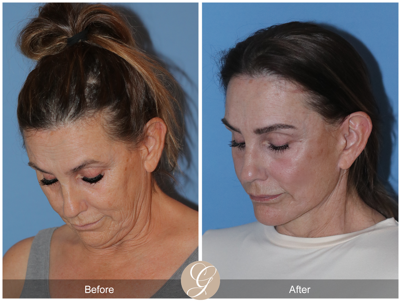 Deep Plane Facelift Case 25 Image