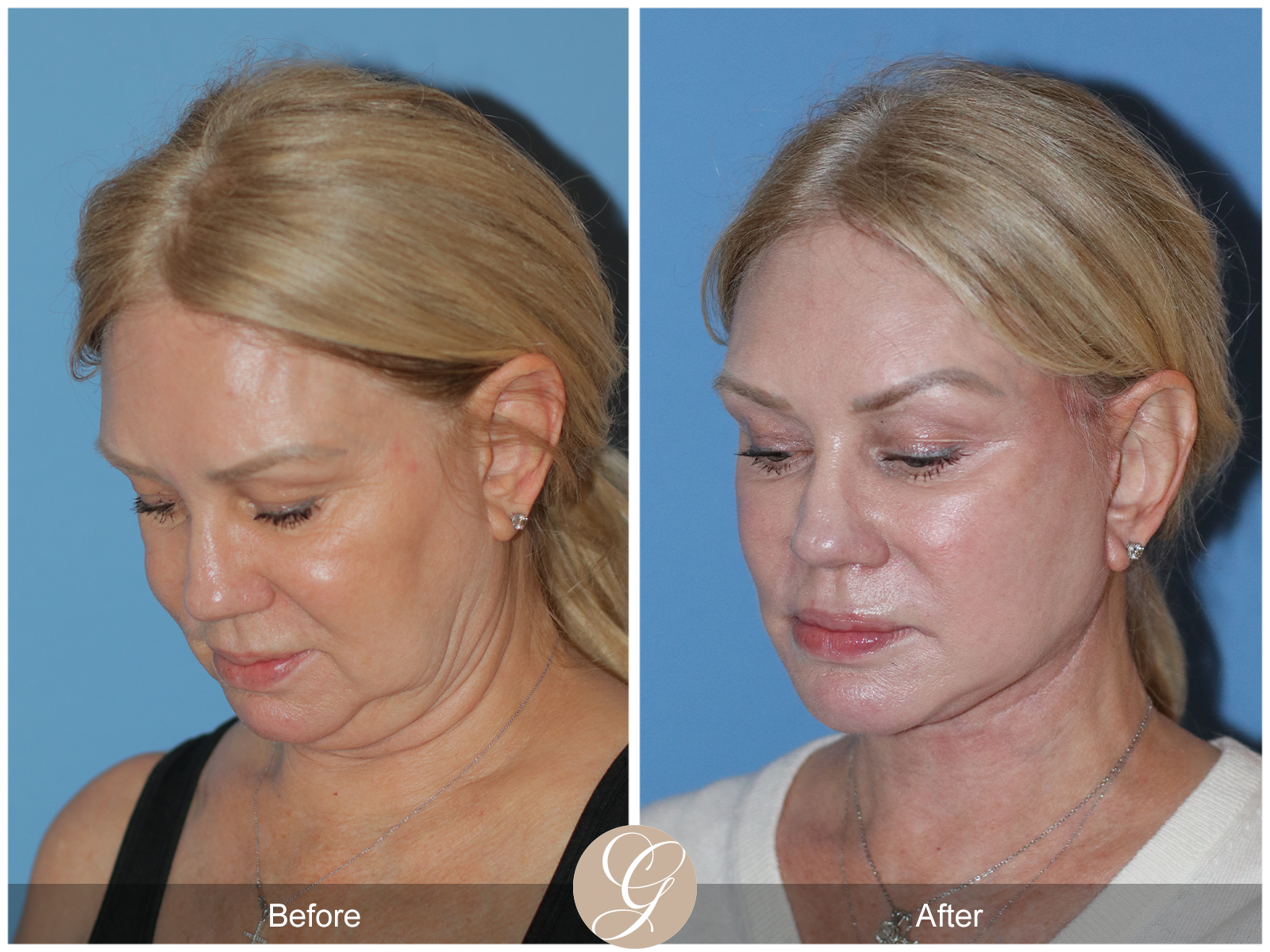 Deep Plane Facelift Case 26 Image