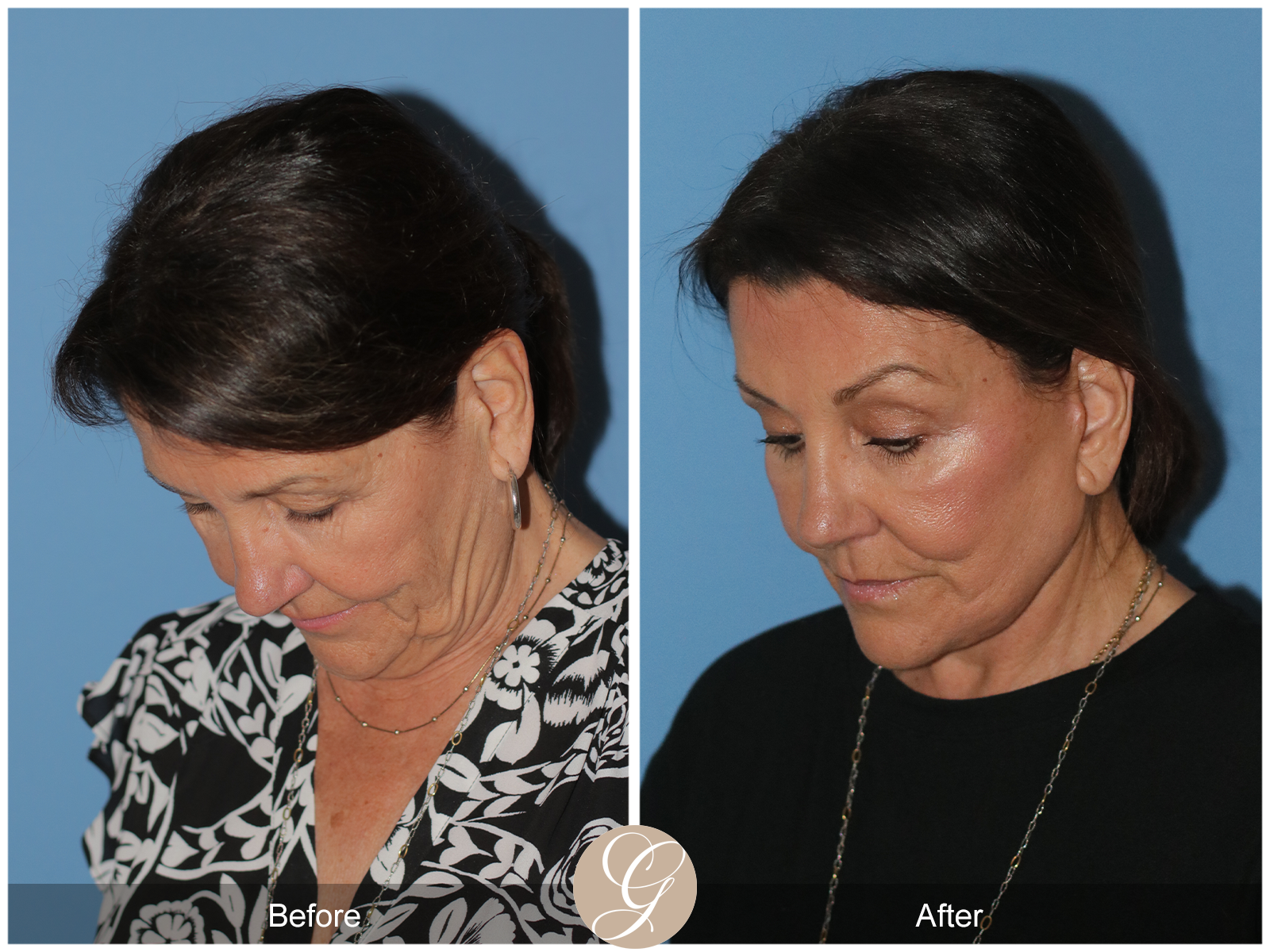 Preservation Deep Plane Facelift Case 25 Image