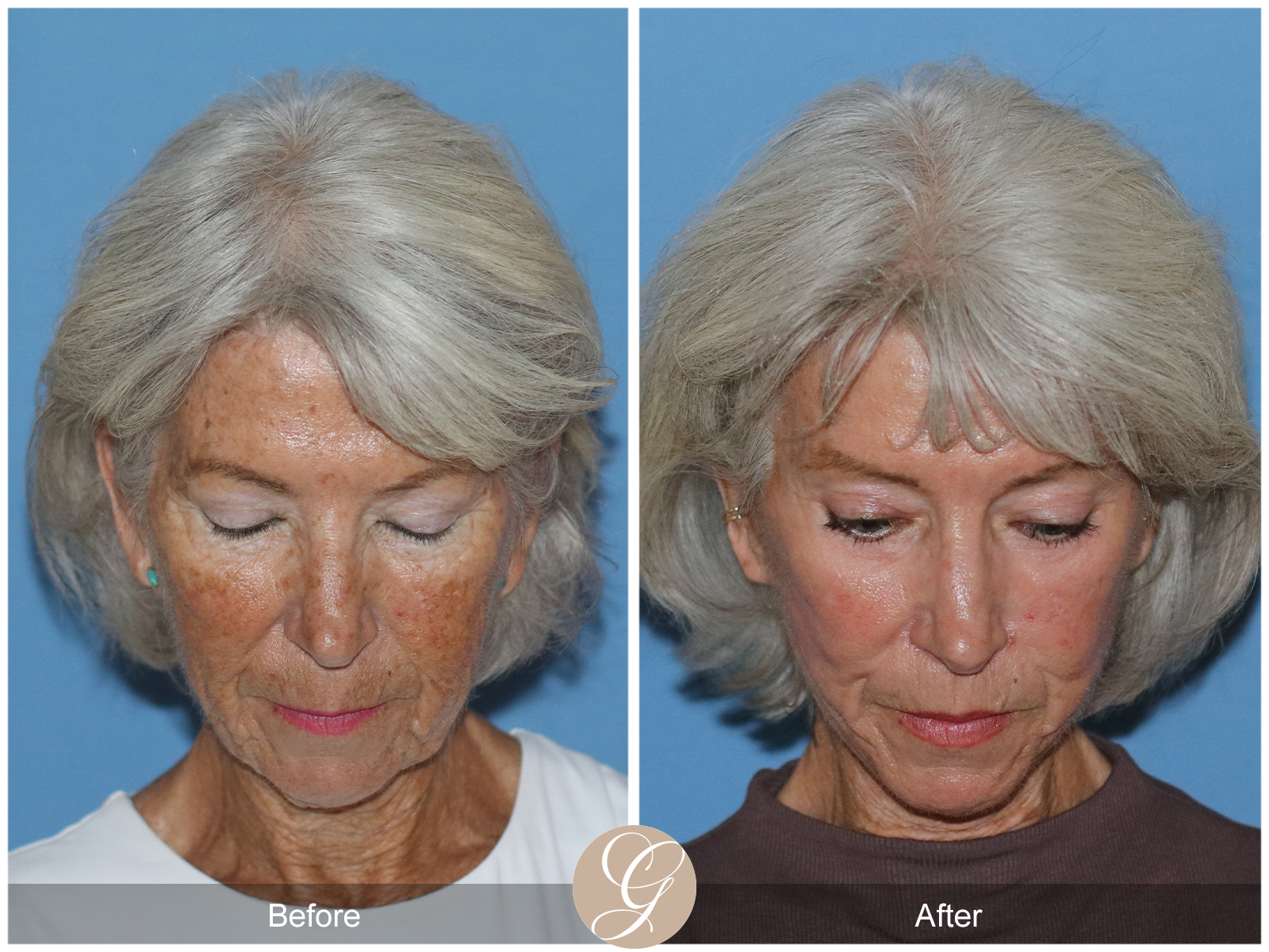 Preservation Deep Plane Facelift Case 24 Image