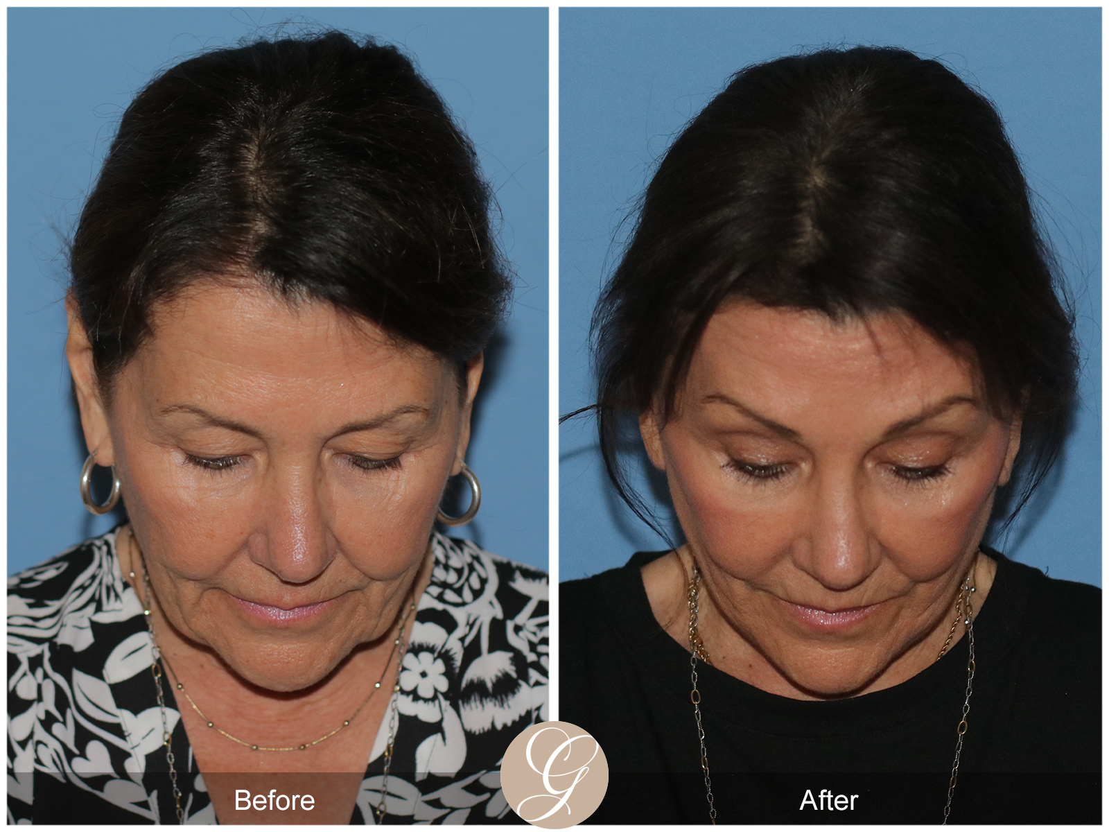 Preservation Deep Plane Facelift Case 25 Image