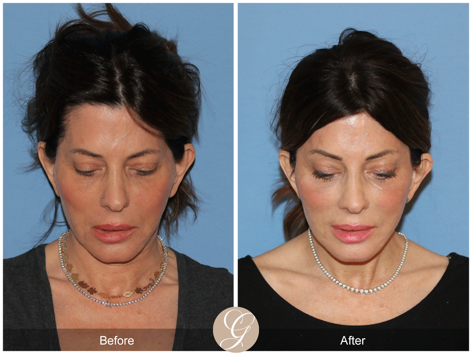 Preservation Deep Plane Facelift Case 27 Image