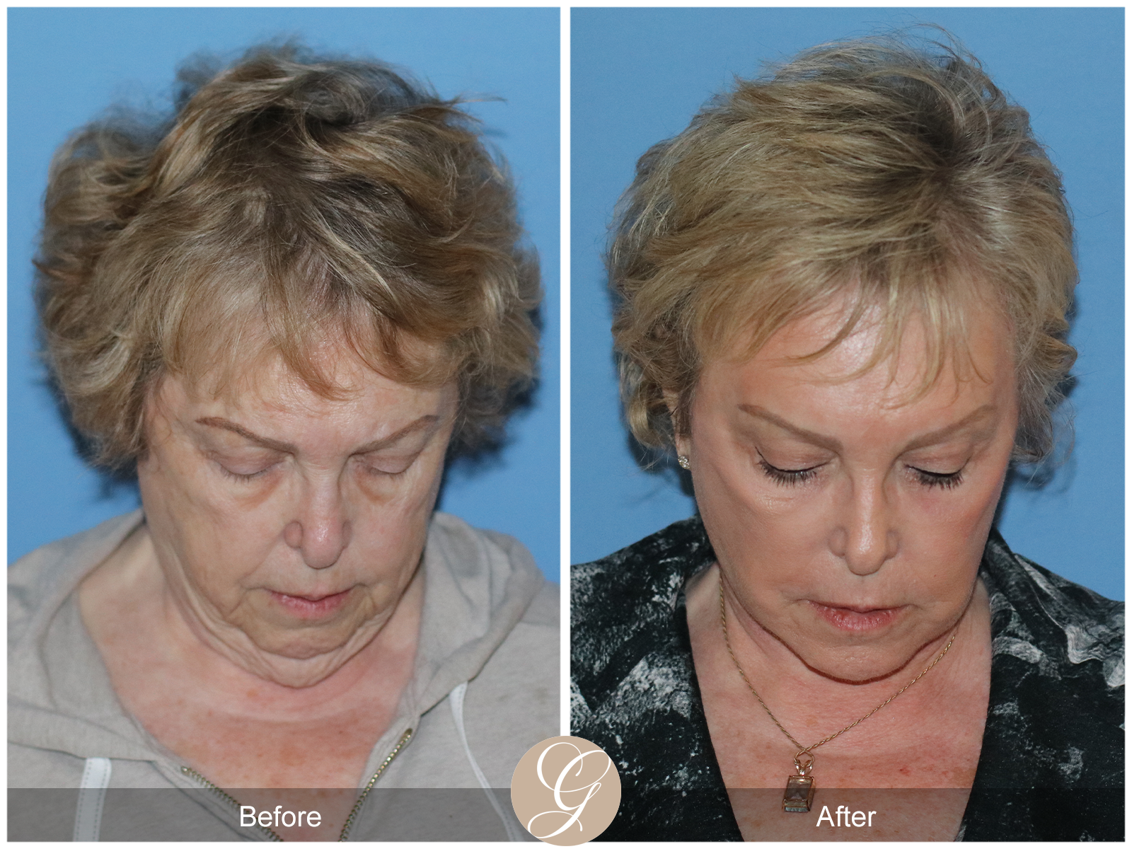 Preservation Deep Plane Facelift Case 31 Image