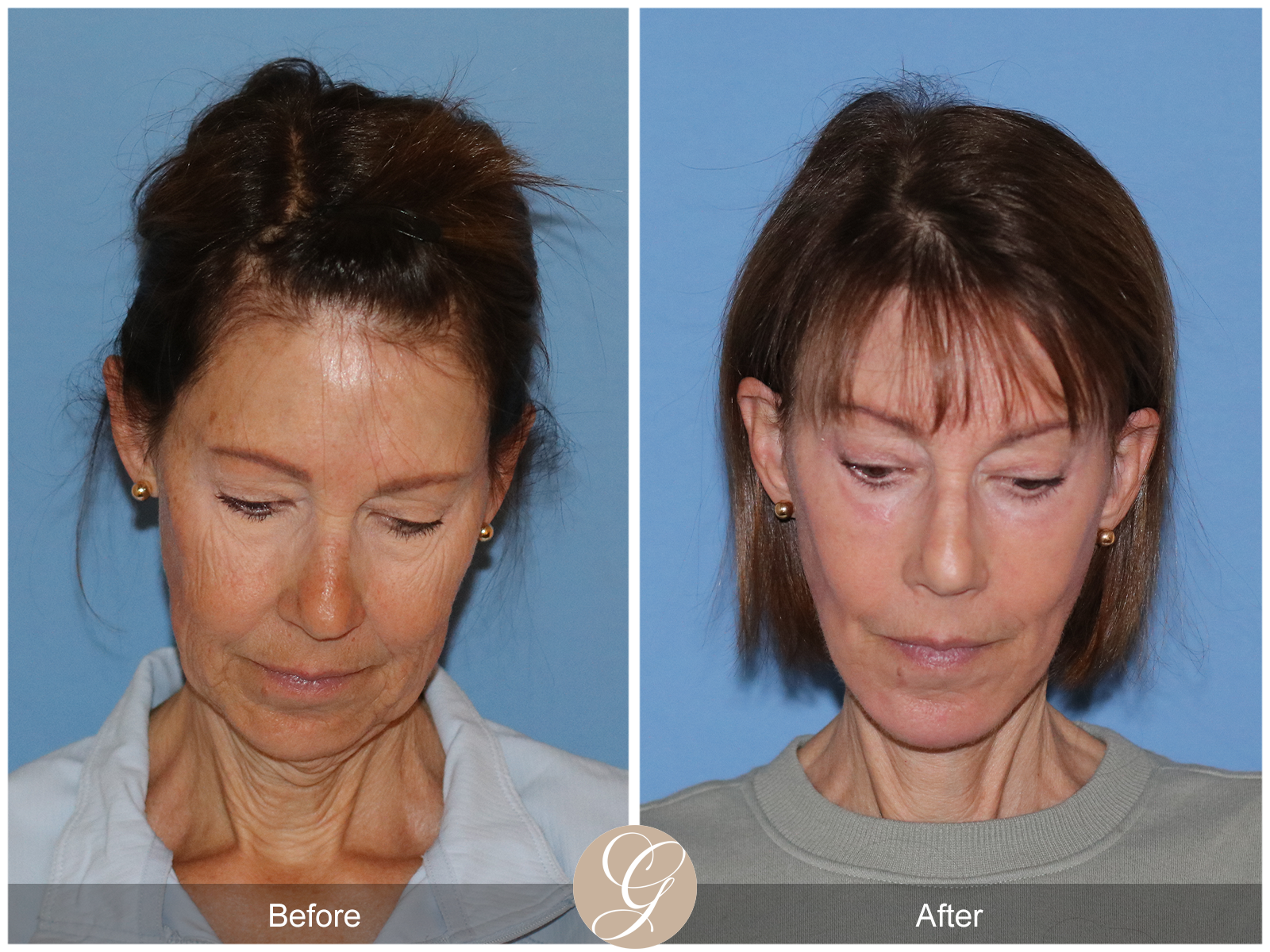 Preservation Deep Plane Facelift Case 32 Image