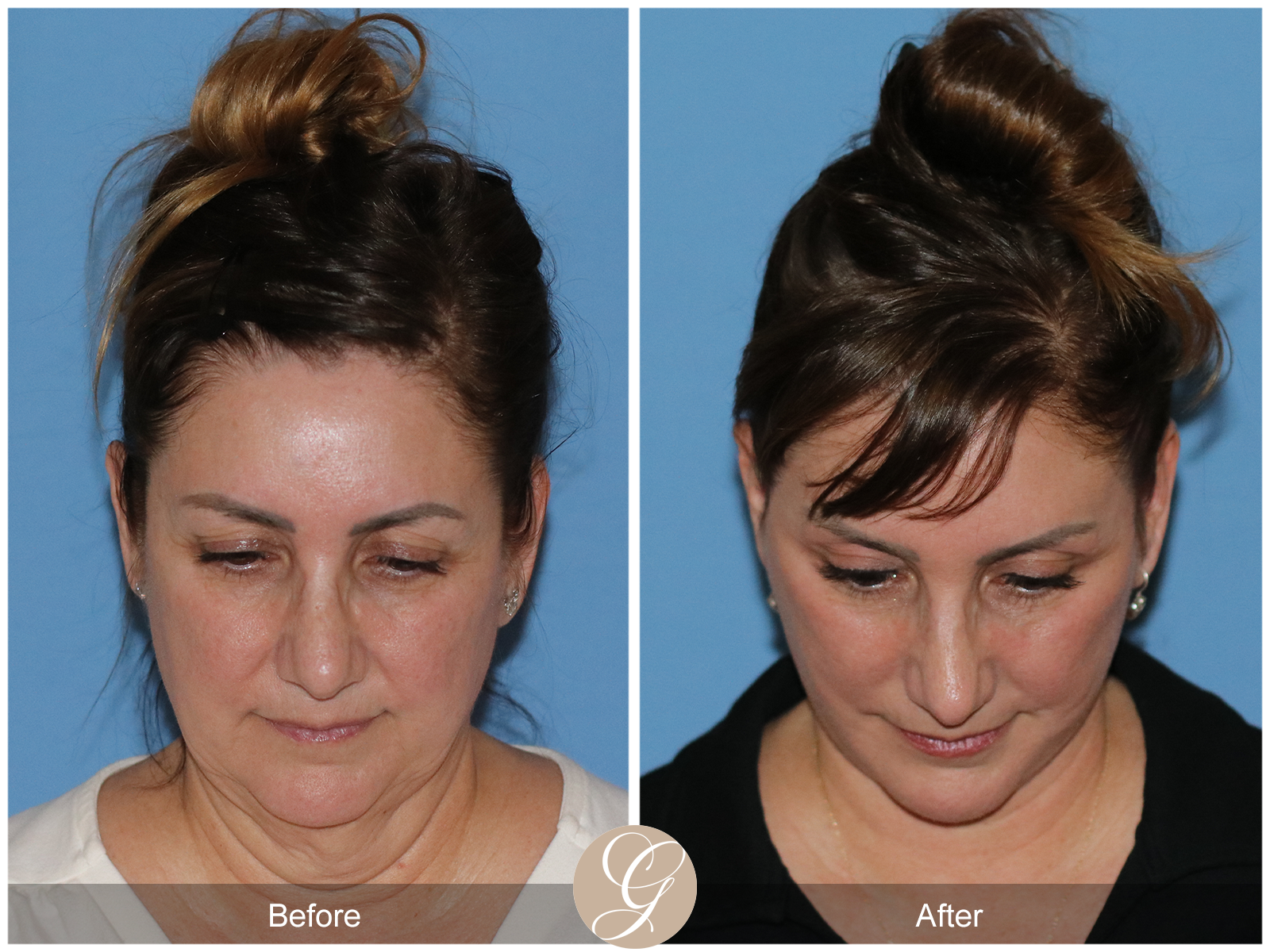 Preservation Deep Plane Facelift Case 33 Image