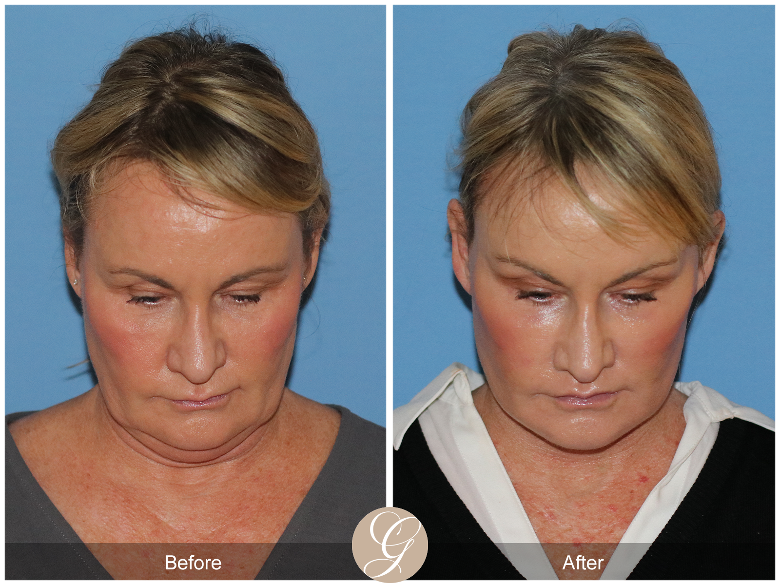 Preservation Deep Plane Facelift Case 34 Image