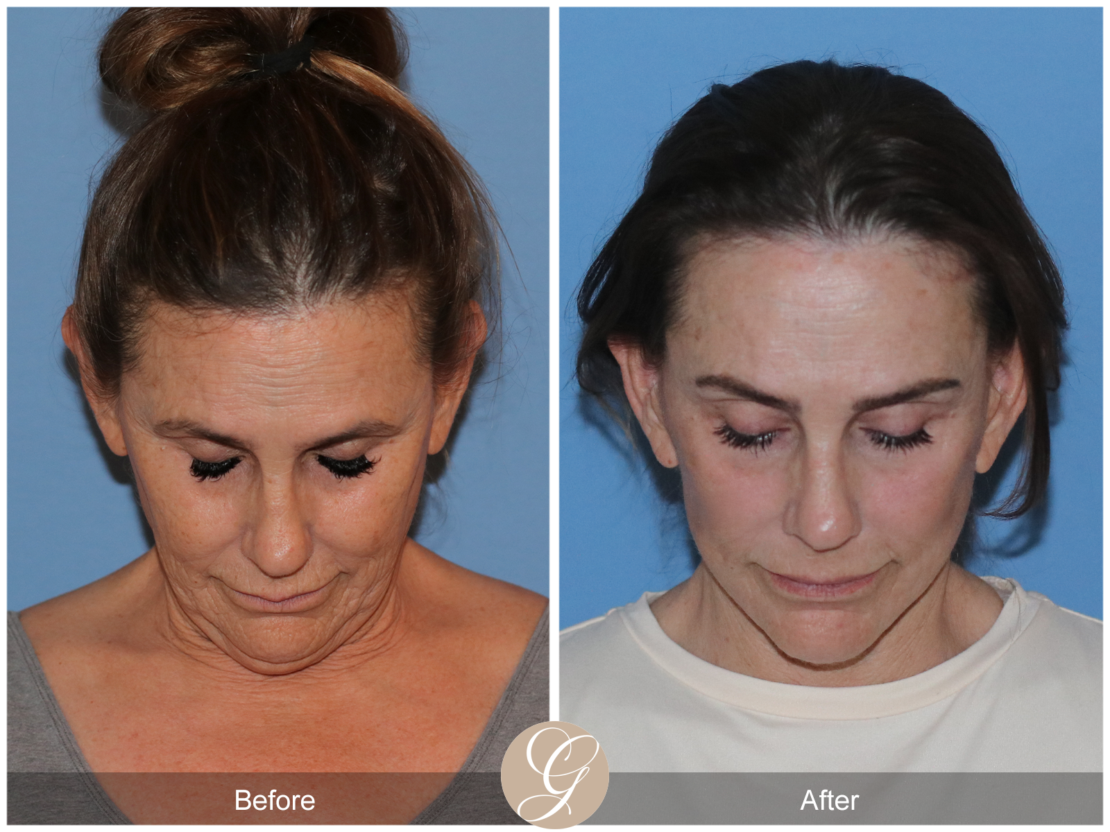 Deep Plane Facelift Case 25 Image