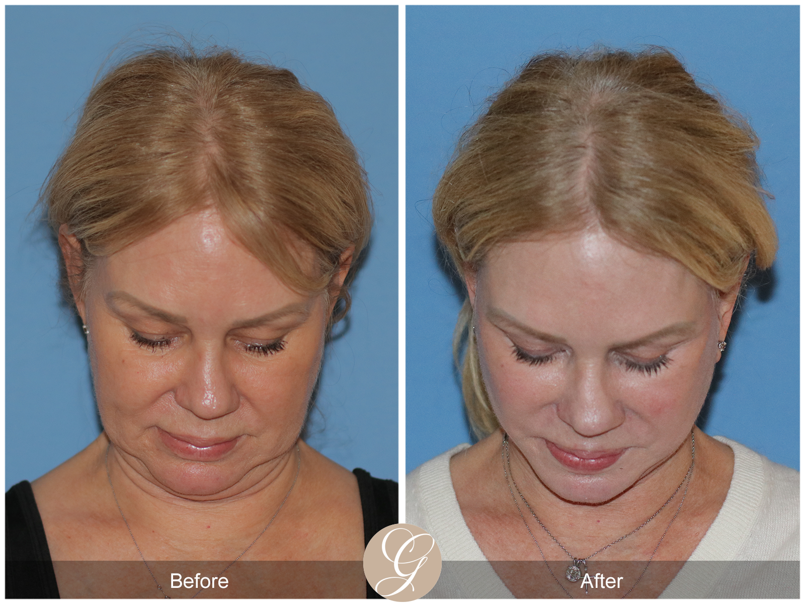 Deep Plane Facelift Case 26 Image