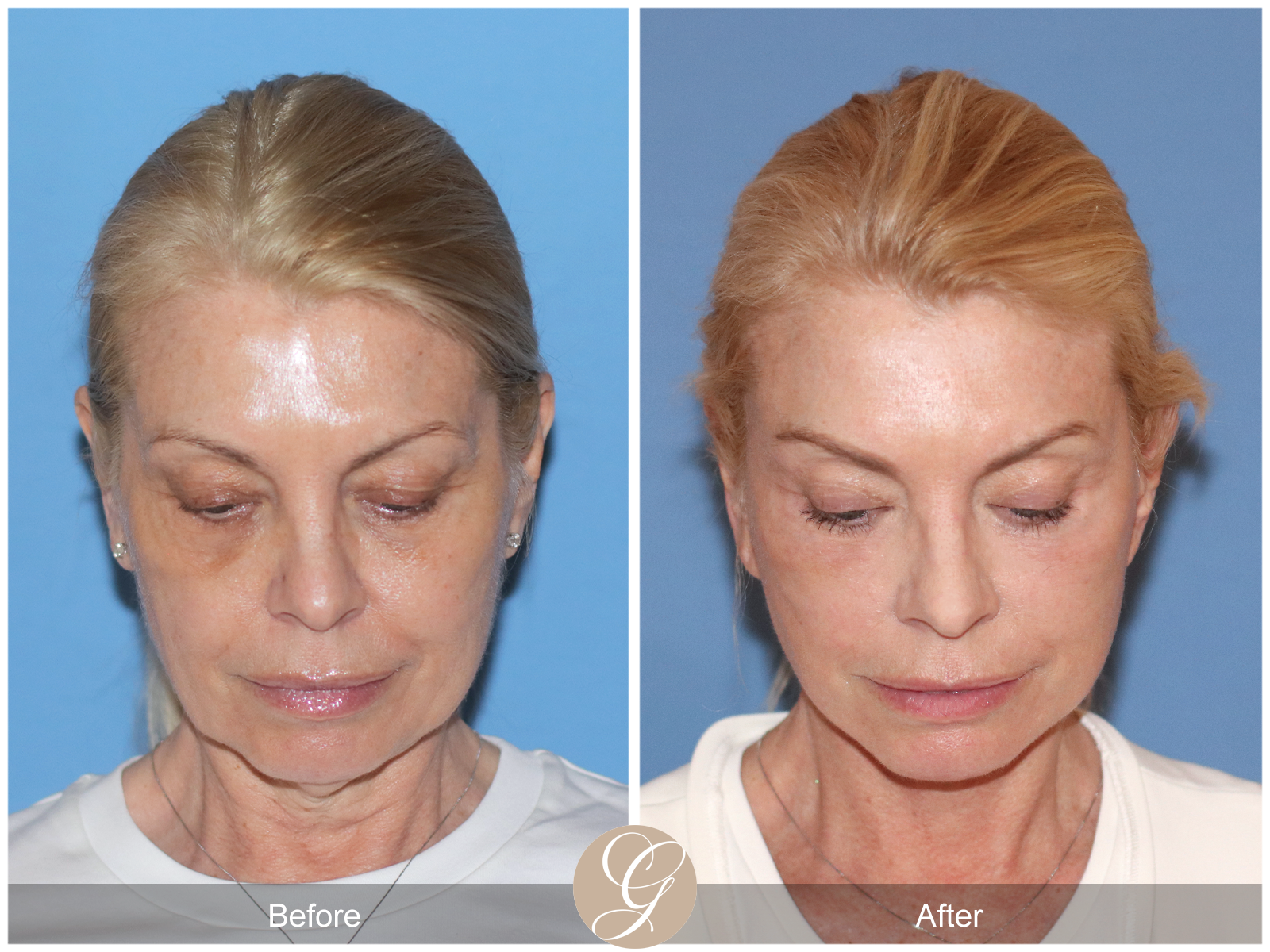 Preservation Deep Plane Facelift Case 26 Image