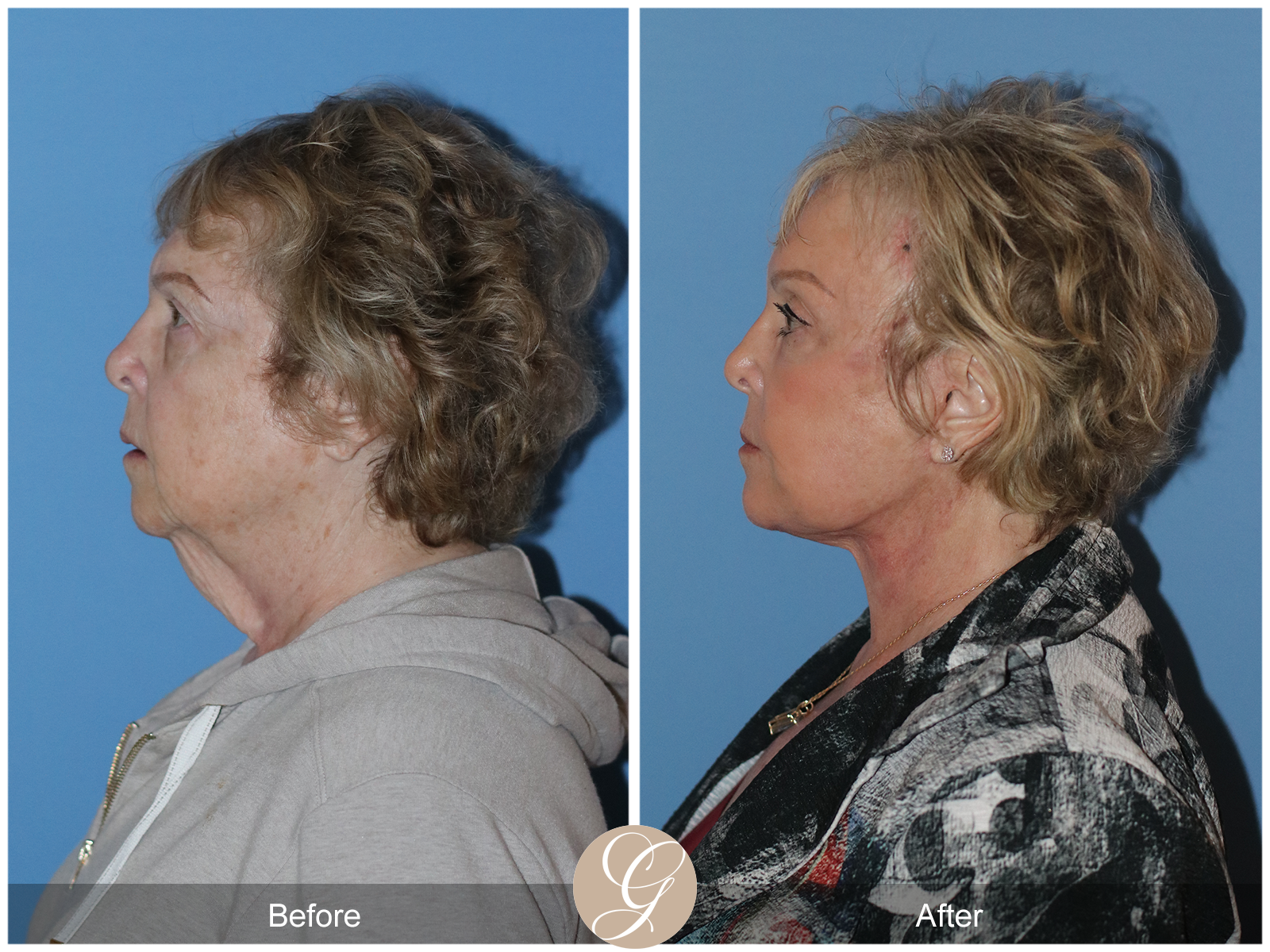 Preservation Deep Plane Facelift Case 31 Image