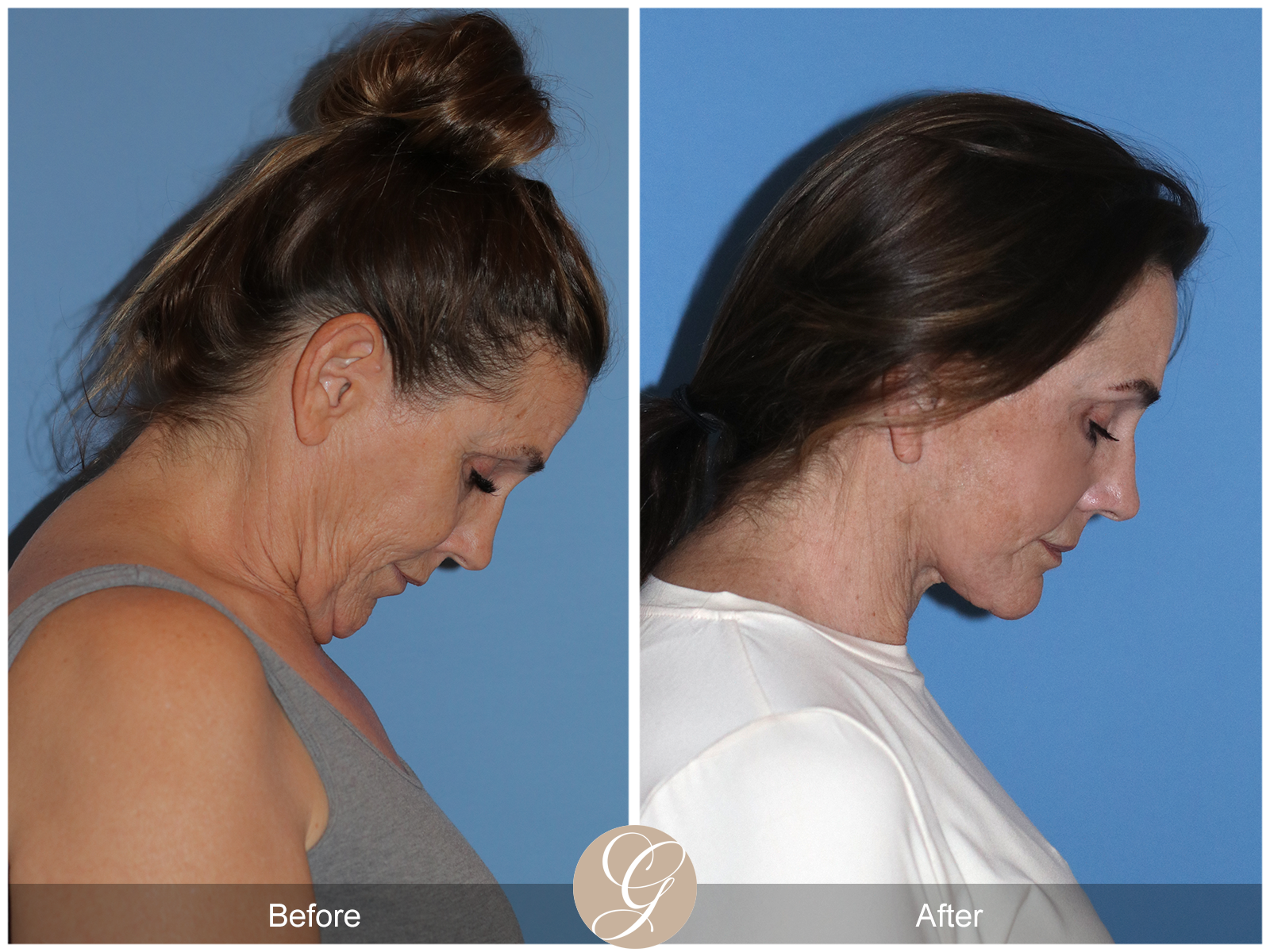 Deep Plane Facelift Case 25 Image